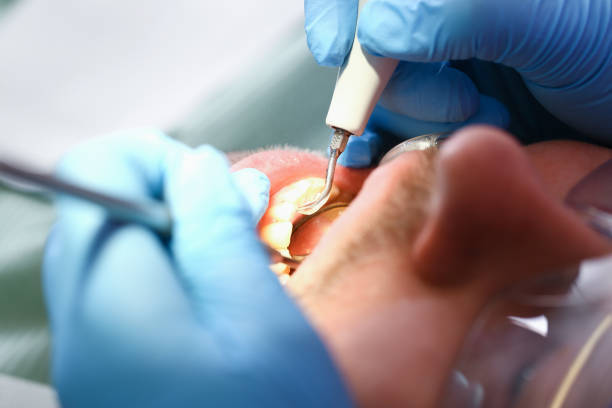Best Emergency Dentist for Lost Fillings or Crowns in Palmview South, TX